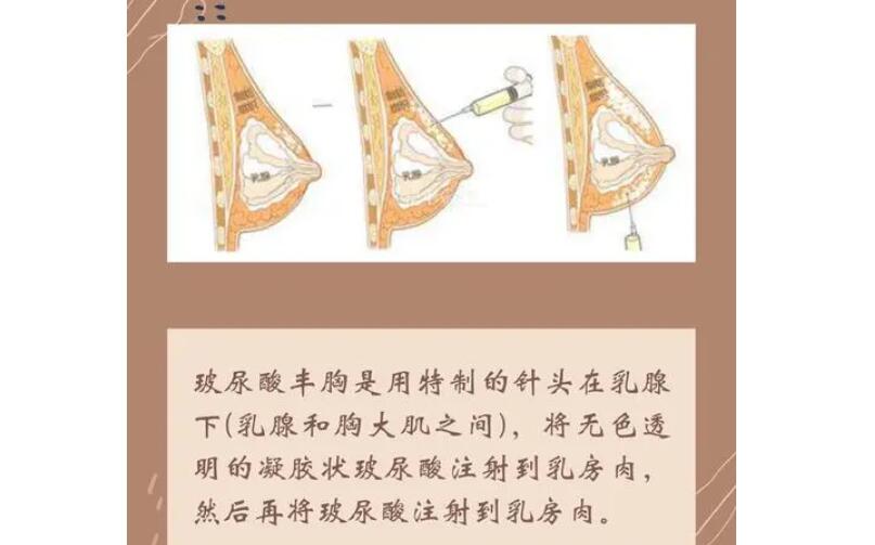 创可贴隆胸多少钱？价格明细_其他可靠的隆胸方式介绍