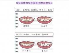 冷光美白牙齿可以白到啥程度？可以维持多久？有伤害吗？