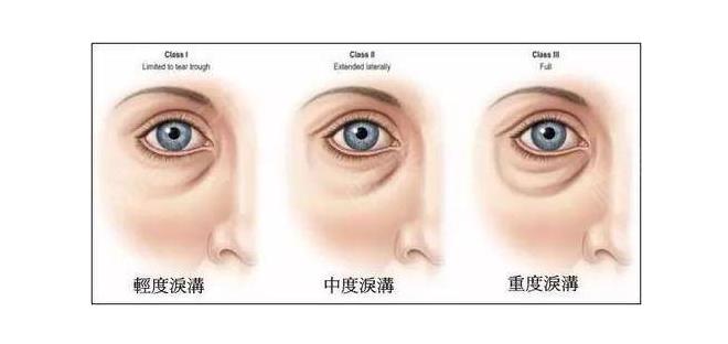 刘光晶医生怎么样？天津公立医院整形科室专家简介_泪沟填充案例