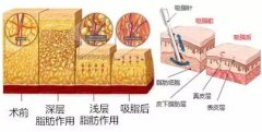 国内抽脂手术成熟吗？抽脂危害\水动力抽脂优点介绍