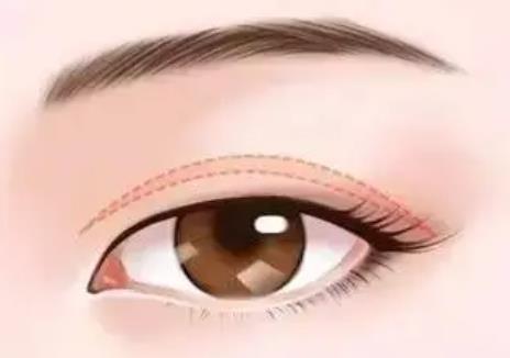 宋楠医生双眼皮案例介绍！医生的手术风格如何呢？对比照