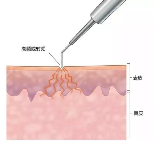 激光点痦子会留疤吗？原理、优势、术后护理盘点