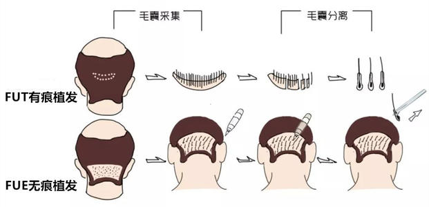 李宇飞植发怎么样？个人资料简介_价格表抢先看！