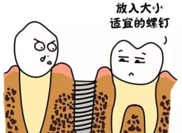 上海摩尔口腔医院种植牙多少钱？收费贵不贵？院内口碑医生推荐