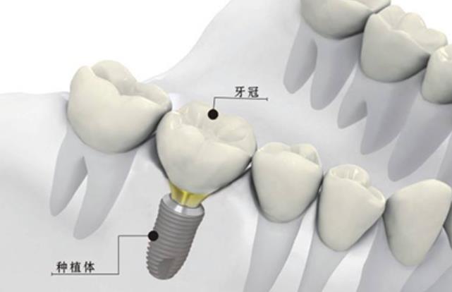 上海凯润口腔医院种植牙价格贵不贵？真人做牙齿种植案例图来了！