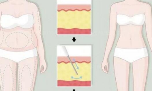 【臀部吸脂】臀部吸脂有风险吗，恢复过程有多久！