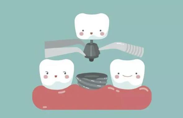 牙博士种植牙怎么样？种植牙技术优势有哪些？科普篇