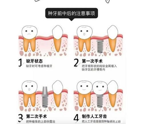 上海科瓦口腔种植牙价格表23年更新！附门诊部实力、技术优势介绍