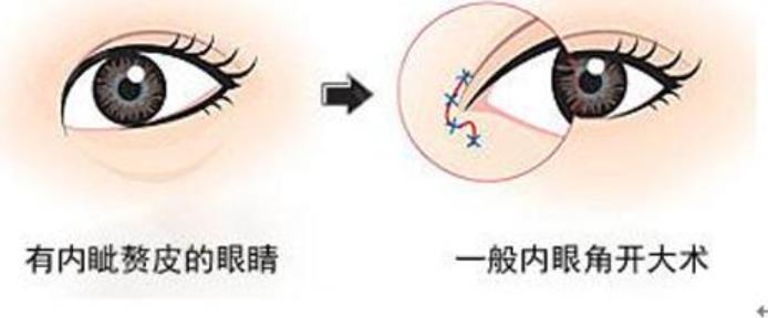 上海雪机医疗美容诊所双眼皮多少钱？院内真人眼部案例介绍！