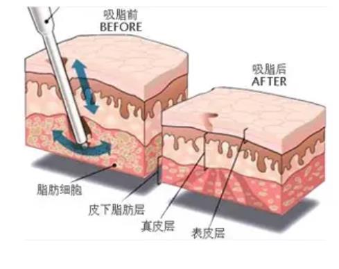 袁玉坤吸脂案例曝光！真人做吸脂手术前后对比照大公开！