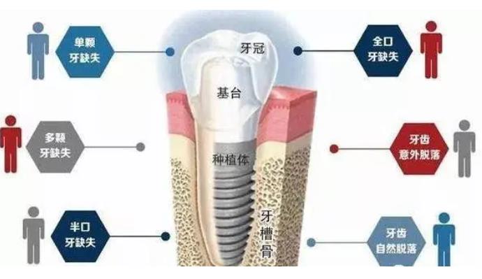 上海市口腔医院种植科怎么样？真人做牙齿种植案例曝光！价格表
