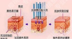 伯思立激光嫩肤贵吗？价格费用\院内医生实力点评！