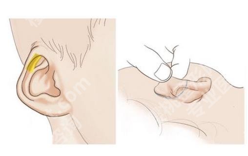 上海一美整形外科医院耳再造技术怎么样？医生、价格