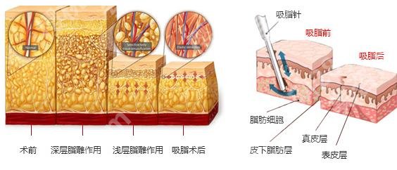 上海微加医疗美容门诊部张亚伦医生怎么样？个人简介、腰腹吸脂案例！