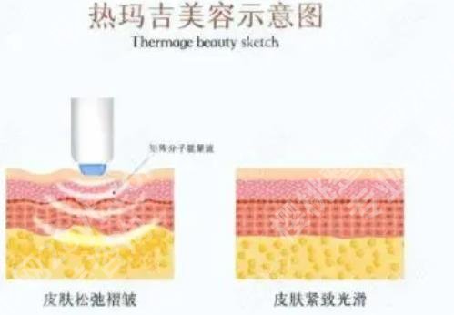 上海艺星热玛吉是真的吗？是认证机构吗？热玛吉效果介绍