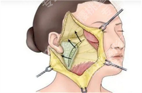 上海琥裳医疗吴佳君拉皮技术怎么样？案例前后对比图，价格表