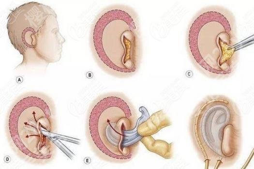 上海一美整形外科医院耳畸形手术费用是多少？医生口碑，案例