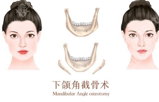 上海何晋龙和宋茂启谁技术好？何晋龙医生下颌角整形案例点评，价格