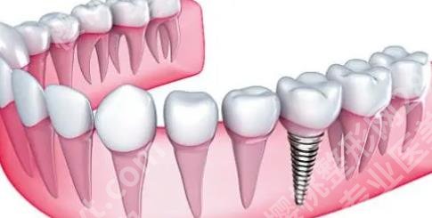 上海智星口腔门诊部种植牙怎么样？技术优势介绍！案例图