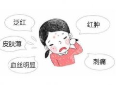 雅漾去红血丝有效吗？红血丝形成原因有哪些？速速了解