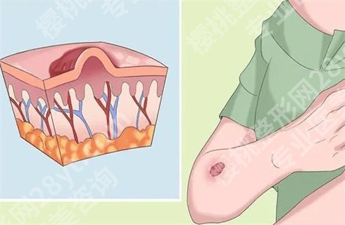 凹陷性疤痕怎样调节？如何修复，这些小秘方你知道吗？