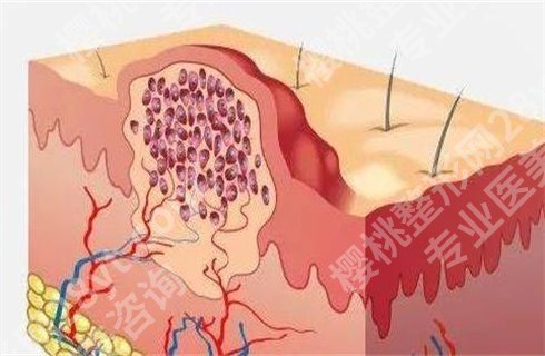 凹陷性疤痕怎样调节？如何修复，这些小秘方你知道吗？