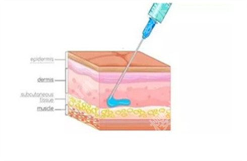 注射美容的注意事项？这几个细节你了解吗？速来了解