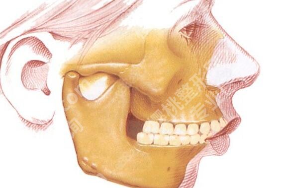 脸部骨骼变形能矫正吗？效果怎么样？有什么注意事项吗？