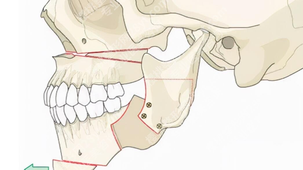脸部骨骼变形能矫正吗？效果怎么样？有什么注意事项吗？