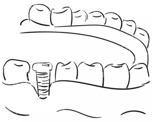 杭州种植牙齿价格多少？设备更新和先进的技术可以提高调节效果！