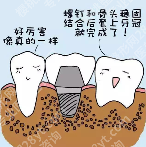 济南种牙多少钱一颗啊？多颗种牙价格和单颗牙的价格是不一样的！