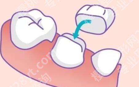 全瓷冠多少钱一个？全瓷冠具有更好的透明度和质感！