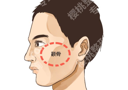 上海伊莱美做颧骨内推怎么样？内含医院信息介绍