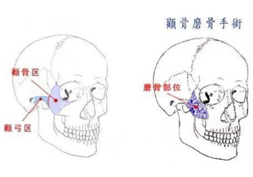 颧骨高有什么办法改良？术前科普大盘点！