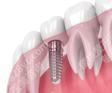 全瓷牙和种植牙哪个伤害小？看一看具体的分析和对比吧！