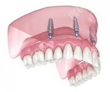 缺牙的3种修复方式哪种比较好？含有详细的修复方式分享！