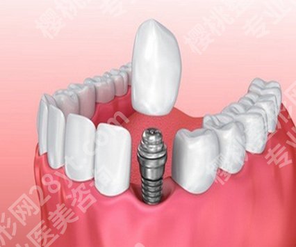 台州种植牙多少钱一颗？从综合考虑价格、医生资历来看价格！