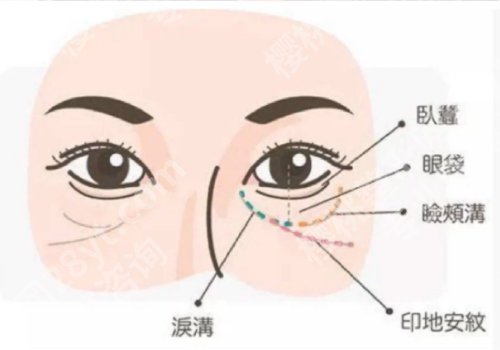 印第安纹和泪沟的区别有哪些？可以通过注射改良