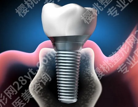 现在种一颗牙要多少钱一颗？因地区、医院及患者的具体情况而有所不同！