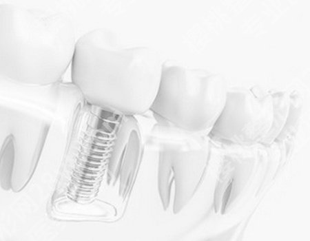 镶牙和种植牙价格大概是多少？其他的牙齿调节还会增加镶牙的价格！