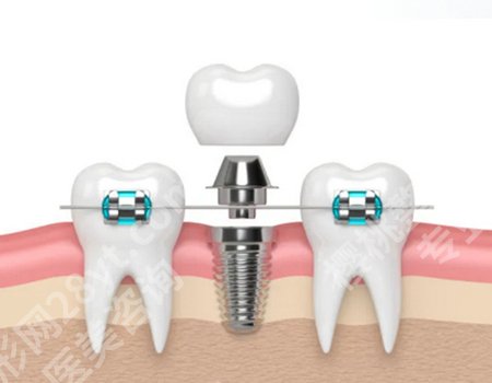 正规医院种一颗牙要多少钱？手术费/种植体费/ 麻醉费都算在里面！