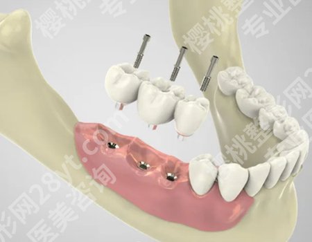 种牙加骨粉需要多少钱？综合考虑费用、技术和设备等因素决定价格！