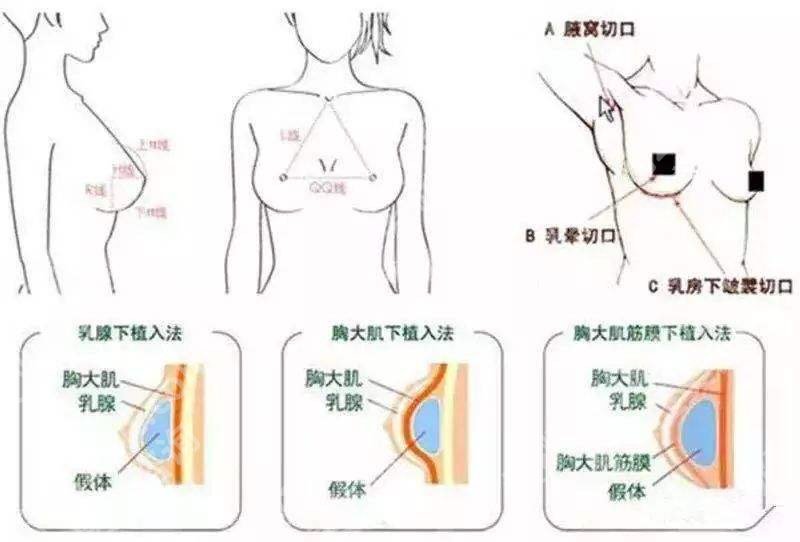 广州冯传波隆胸怎么样？医生简介、技术优势揭晓！