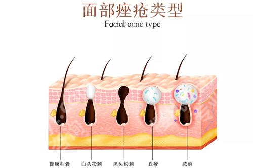 额头长了很多密密麻麻的小痘痘是什么原因？要怎么护理？