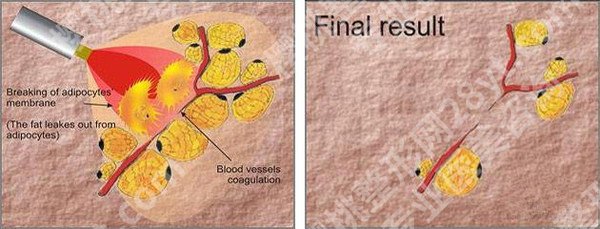 吸脂肪对身体有害吗？费用、恢复时间、注意事项等汇总