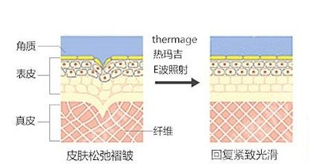 热玛吉一次多少钱？价格费用明细、功效作用揭晓！