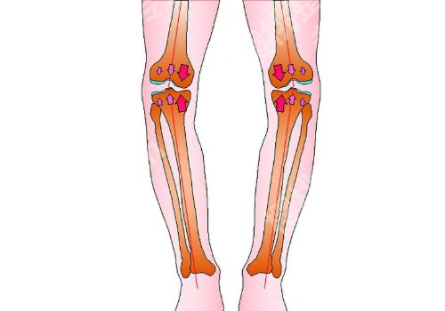 如何矫正o型腿？几种好的方法快快收藏起来！
