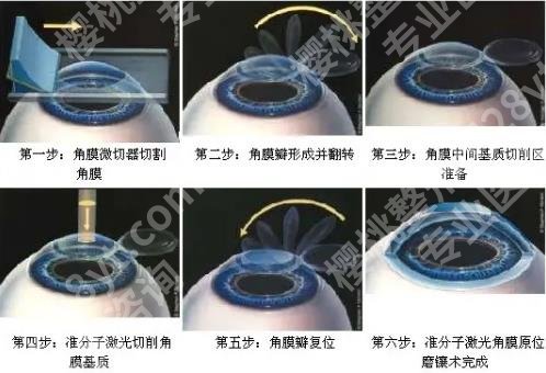 准分子激光近视手术原理是什么？有哪些优势和弊端