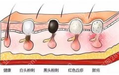 鼻子上有黑头怎么办？有什么好的方法可以去掉吗？科普知识汇总