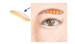 韩式提眉和无痕提眉的区别是什么？手术方法、恢复时间等分析！